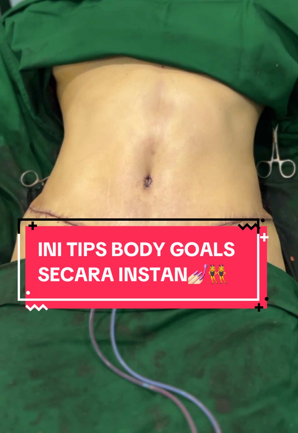 Perut buncit & kulit kendor setelah melahirkan? 😩 Saatnya Full Tummy Tuck! 💉✨ Kulit lebih kencang, lemak berkurang, dan bentuk pinggang lebih tegas. #perutbuncit #melahirkan #gendut #tummytuck #operasi #surgery #klinikkecantikan #tip #beautylogicaclinic #bandung #CapCut 