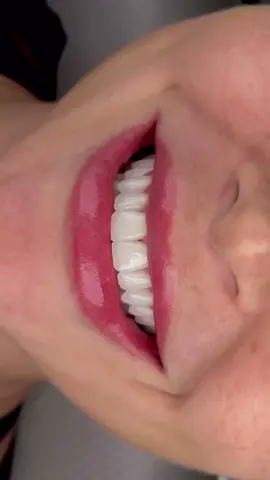 Cười tươi mà không cần che miệng nữa 😁” #xuhuong #tiktokviral #thinhhanh #xh #dán_sứ #trending #nhakhoa #Veneer #TựNhiênTốiĐa 
