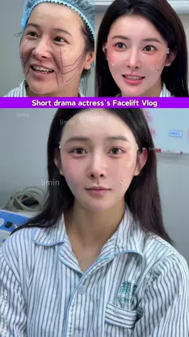 #babyface #9Dfacelift#Faciallift#FacialRejuvenationSurgery#plasticsurgery #Youthfulface#foreheadlift#smilelines