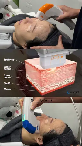 Lift Without Surgery – HIFU Treatment✨  As we age, the SMAS layer (the muscle layer that keeps our skin lifted) starts to lose strength — causing sagging, deeper smile lines, and jowls. HIFU (Highly Intensely Focused Ultrasound) targets that exact layer, delivering ultrasound energy to contract and tighten the collagen + elastin. Results keep improving for 3–4 months as new collagen forms. Benefits: ✔️ Tightens and lifts skin naturally ✔️ Only 1–2 sessions a year needed ✔️ Safe for face and neck ✔️ No downtime, no incisions ✔️ Low discomfort ✨ Great for lifting the jawline, reducing a double chin, and refreshing the entire face. 📩 DM us to book your consultation and see how HIFU can give you a fresher, more lifted look. Tap the link in bio for a free online consultation. 💌 Send us a DM or contact us at: • renovoskinclinic@gmail.com • +82-10-8862-7757 (WhatsApp/KakaoTalk) •📍Apgujeong Station Exit 4 #HIFUKorea #SkinTightening #NonSurgicalLift #KBeautyClinic #JawlineLift #SMASLayer #FaceLiftingKorea #KoreanAesthetics #CollagenBoost #SGMGlow #RenovoClinic #AmoaGlow 