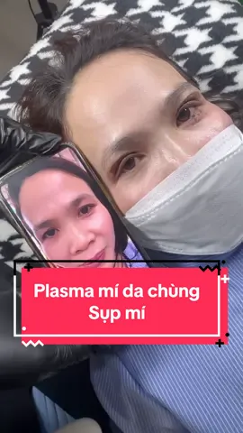 Plasma mí da chùng - sụp mí tại nhà Giang Beauty #xuhuong2025🍀🍀 #kim7magnum #phunmoitanvien #GiangBeautyplasma #plasmafibroblast #phunmoidep 