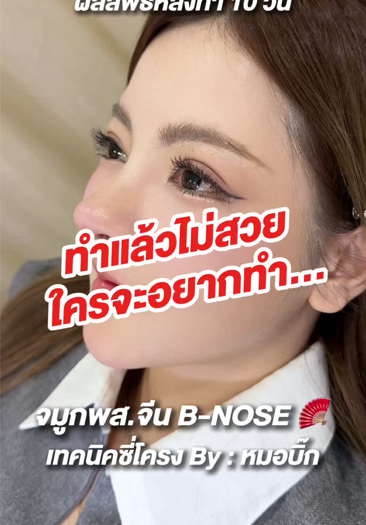 ทำแล้วไม่สวย ใครจะอยากทำ! มีดูพัฒนาการของน้องโอปอล์ลูกสาวหมอบิ๊ก กับจมูกพส.จีน ทรงปัจจุบันกันค่ะ 💖 #S45Clinic #หมอบิ๊กs45clinic #เสริมจมูก #เสริมจมูกโอเพ่น #แก้จมูก #รีวิวจมูก #พสจีน #ทรงจมูกพสจีน #bnose @หมอบิ๊ก S45 Clinic @โอปอล์ไตเติ้ล @โอปอล์ไตเติ้ล ช่องสำรอง 