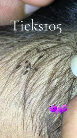 Remove lice#😱😱😱omg #😭😭😭 #liceremoval #🥶🥶🥶 #like 