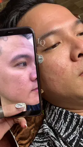 Cập nhật Da Sẹo#chamsocdaseo#chamsocda#chamsocdamun#chamsocdanam#tanbinh#govap #Lequynh#Lqspa#hocnghespa  #chamsocda #lequynhspa #vienthammylqspa #nanmunbangtay #nanmunbangtambong#nanmunbangcay