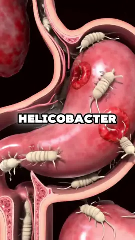 If you're suffering from Helicobacter pylori bacteria, gastritis, or acid reflux, I recommend you watch this video all the way to the end. #health #healing #healthy #healthcare #healthtips #healthtip #natural #nature #nutrition #helicobacterpylori #gastritis #acidreflux 