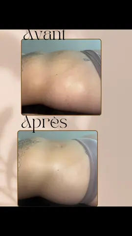 #drainagelymphatique #postoperatoire #BienÊtre #VentrePlat #Massage #TechniqueColombienne 