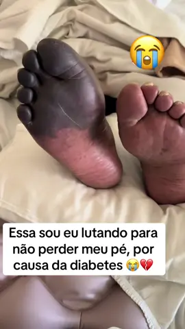 Essa sou lutando contra a diabetes para não perder meu pé, aos 30 anos de idade 😭💔 #diabetes #diabetestipo2 #hospital #pe 