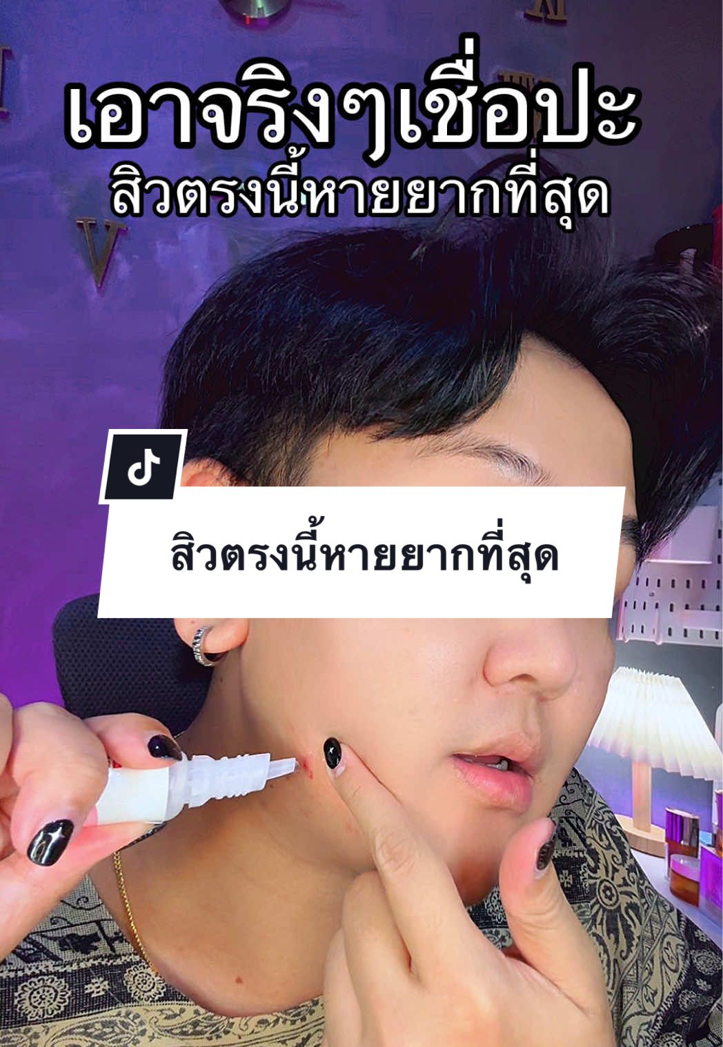 สิวตรงนี้ หายยากที่สุด  @โซว'ชอบฟังเพลงเศร้าา  #เจลแต้มสิว #เจลแต้มสิวเมดิต้า #เมดิต้า #สิว #สิวกรอบหน้า #สิวไต #tiktokshop88ดีลลดด่วน 