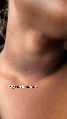 Use this if other actives are too strong for your skin and thank me later. #skincare #darkneck #koreanskincare #vitamincserum #dralthea #ampoule #sensitiveskin #darknecktreatment #serum  Dark neck  Sensitive skin Dr Althea  Vitamin c serum 