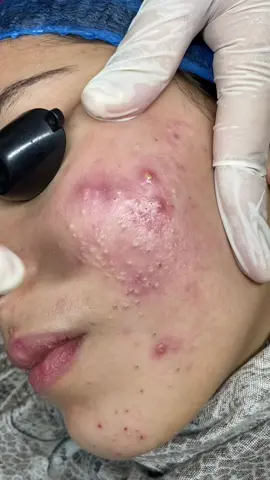 جلسات تنضيف البشره لازم تكون مع كورس علاجي عشان حبوب الشباب تنتهي حاله بنوته بتعاني من حبوب الشباب وبدأنا معاها في اول جلسه علاجيه ومكملين ❤️#علاج_حب_الشباب #تقشير_البشرة #تنضيف_بشره 