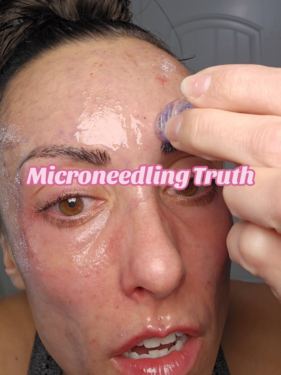 If you're in your 30s and starting to notice fine lines, this at-home microneedling kit might actually be worth it. I was NOT ready for how painful it was—but the results? My forehead lines and 11s almost disappeared. Qure’s micro-infusion system seriously tightened my skin, and it’s on MAJOR sale right now. Real results, no influencer filter. #over30skincare #fineLines #antiagingroutine #qureskincare #realreview 