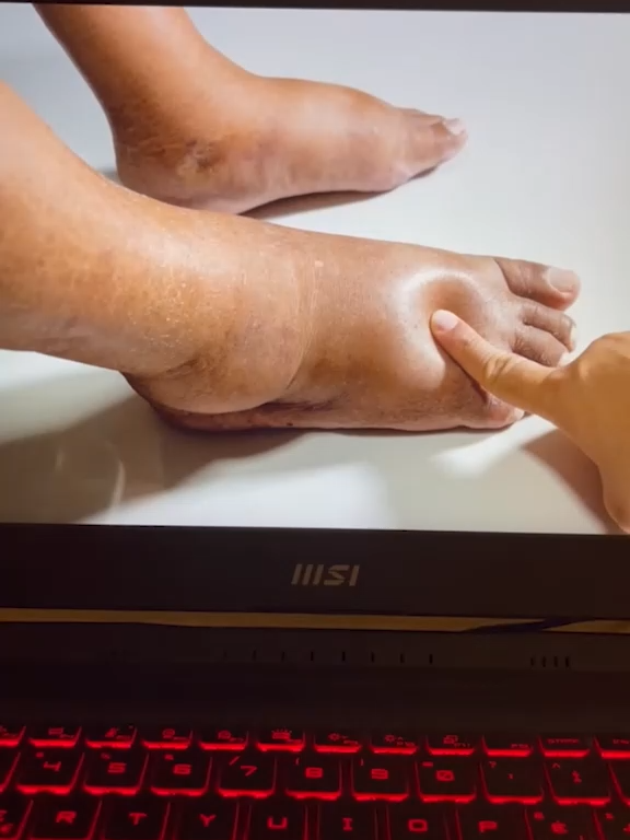 ودّع ألم القدم واحتباس السوائل مع دهان سم النحل الأصلي 💪🐝 حل فعّال للشوكة العظمية، التهاب اللفافة الأخمصية، وانتفاخ القدم. نتائج تلاحظها من أول أسبوع بإذن الله ✨ 🚚 متوفر في السعودية مع توصيل سريع #علاج_الشوكة_العظمية #التهاب_اللفافة_الأخمصية #احتباس_السوائل #دهان_سم_النحل #علاج_طبيعي #ألم_القدم #كعب_القدم #تورم_القدم ##صحة_القدم #اللفافة_الأخمصية #التهاب_القدم #السعودية #تيك_توك_السعودية