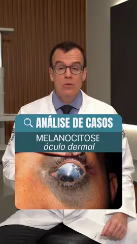 Nevus de OTA ou Melanocitose Óculo Dermal? Estes pacientes tem risco maior de desenvolver glaucoma ou melanoma uveal.  #oftalmologia #saudeocular #casoclinico #oncologia