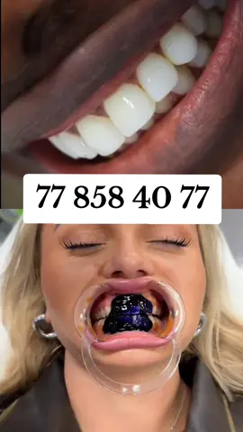 #glorysmile #dentsblanches #dents #dakar #viral_video 