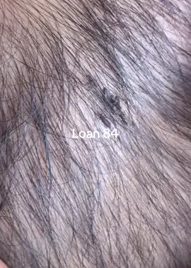 lice removal #lice #😱😱😱 #omg😱😱 #trending 