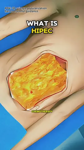 Hyperthermic intraperitoneal chemotherapy (HIPEC) #hipec #hipecchemotherapy #cancer #cancertreatment #chemotherapy #medical3danimation #3dmedicalanimation #cancerawareness