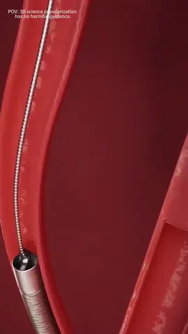 How Rotational Atherectomy is Performed? (3D Animation) #rotationalatherectomy #athrectomy #coronaryarterydisease #coronaryheartdisease #atherosclerosis #arteryblockage #plaque #medical3danimation #3dmedicalanimation