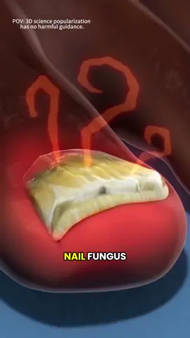 What Is Nail Fungus (Onychomycosis)? #NailFungus #Onychomycosis #FungalInfection #3DMedicalAnimation #ToenailInfection #FungusUnderNail