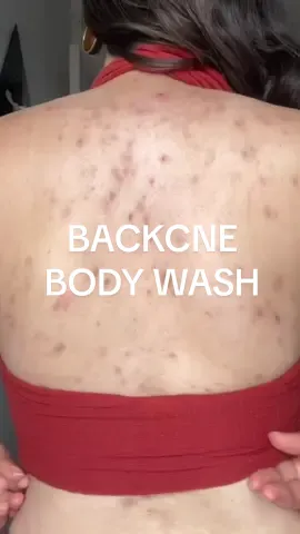 Finallly!!! backne era is over!!😭😫#backacnetreatment #bodywash #sulphurbodywash 