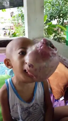 LABAN LANG, ACE!  CALL FOR DONATION: MUKHA NG BATA, HINDI NA MAKITA SA LAKI NG BUKOL SA MATA  Hindi na halos makita ang mukha ng batang ito dahil sa bukol niya sa kaliwang mata. Ang tatlong taong gulang na si Ace kasi, mayroong Retinoblastoma. Isa itong uri ng rare at aggressive type ng kanser sa mata.  Dahil sa sakit, hindi na rin daw nakakakita ang bata. #FYP Para sa mga nais tumulong, maaaring magpadala sa:  Gcash 09758688286 Kristine Joy Bucag  Maya 09978279160 Aidan Mark Alcantara Courtesy: Kristine Joy Bucag