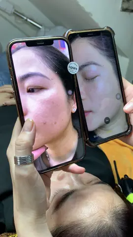 Thực tế da sạm#chamsocdaseo#chamsocda#chamsocdamun#chamsocdanam#tanbinh#govap #Lequynh#Lqspa#hocnghespa  #chamsocda #lequynhspa #vienthammylqspa #nanmunbangtay #nanmunbangtambong#nanmunbangcay