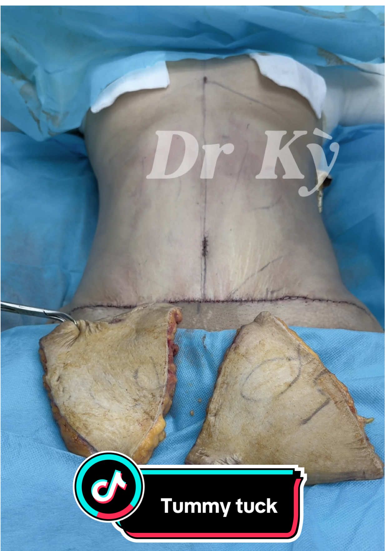 The loose skin on her abdomen has been removed. #BodyConfidence #WaistTransformation #PlasticSurgeryJourney   #BeforeAndAfter #TummyTuck #VietnamClinic #DrKy   #BeautyGoals #SelfCare #BodySculpting #drky #bsky 
