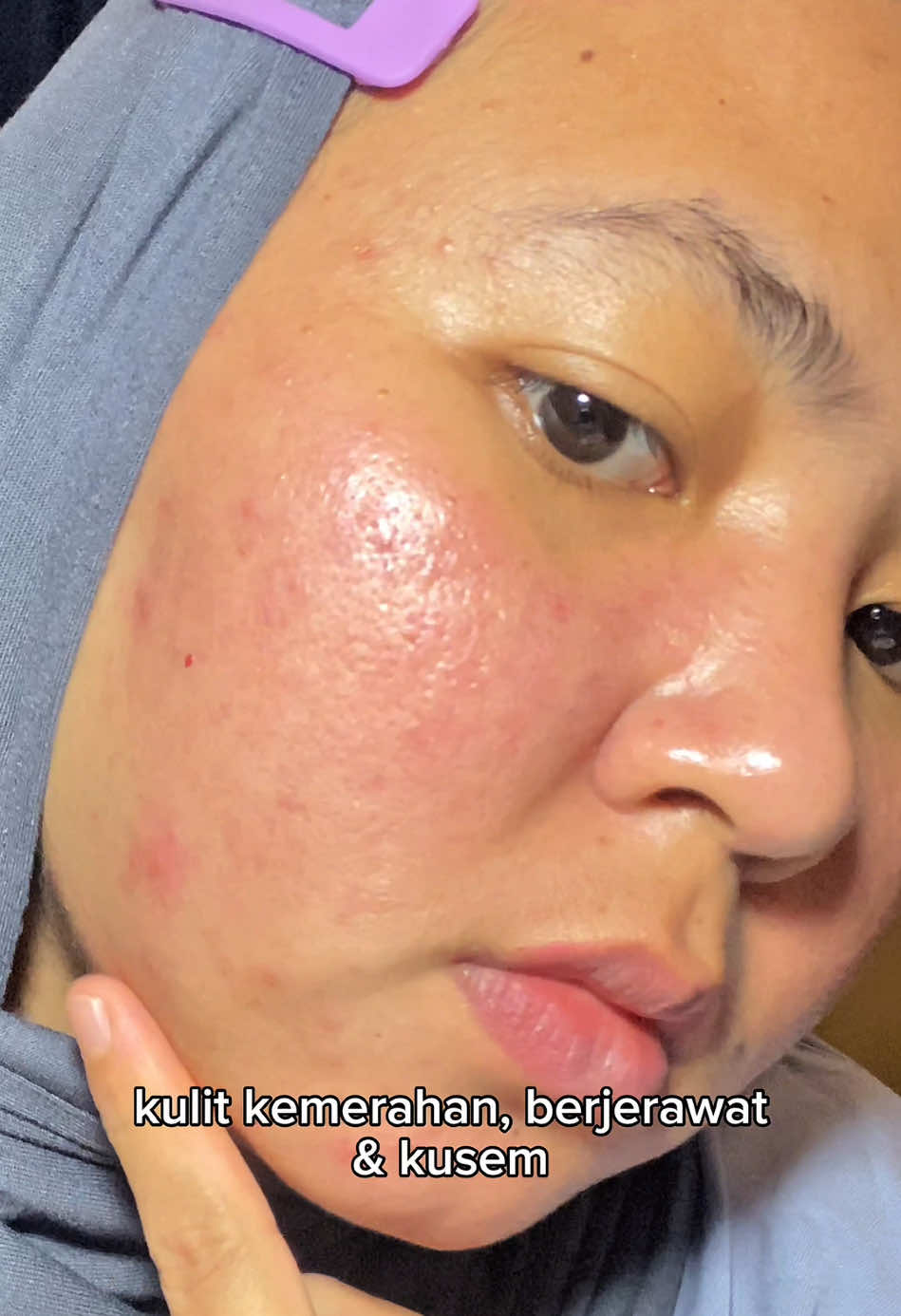 pake mugwort gel mask 15menit kulit berasa langsung calming dan halussss  #jerawat #mugwortgelmaskg2g #acnegelmaskviral 