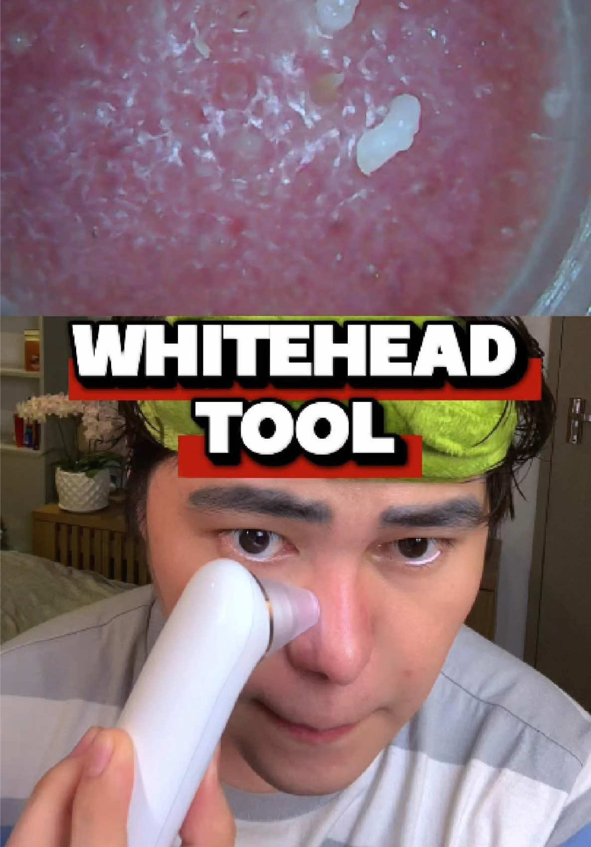 Kung madami kang whiteheads sa ilong, kailangan mo gumamit netong whiteheads tool na nabili ko dito sa shop. Perfect to sa mga nagpa nosejob at may implant sa nose kasi delikado kung ipapa-prick natin nose natin sa derma. #whiteheadsremoval #whiteheadsvacuum 
