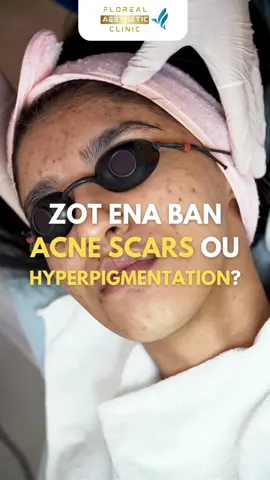 ✨ Transform Your Skin with CO₂ Fractional Laser! ✨   Watch how this advanced laser treatment targets acne scars, wrinkles, pigmentation & open pores — revealing smoother, clearer skin.    Watch till the end to see the incredible before & after results!   Starts as from Rs 4000.   📲Book your session on WhatsApp 5 777 3570 #CO2Laser #SkinResurfacing #FlorealAestheticClinic #GlowUp #LaserTreatment #SkinRenewal