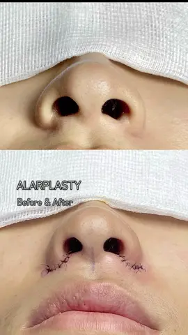 သေးသေးသွယ်သွယ် နှာခေါင်းပုံလေးပဲလိုချင်ပါတယ်ဆိုတဲ့ Client အတွက်လိုက်ဖက်မည့် ပုံစံလေးပြုပြင်ပေးထားပါတယ်✅ #alarplasty #surgery #09 777756461 #foryou #fyp #beauty #aesthetic 