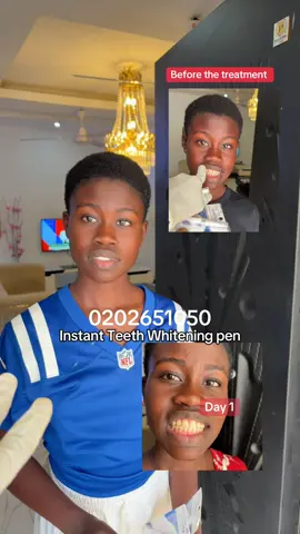 7 days teeth whitening pen. It’s very effective and brings your teeth shade 4 times whiter. Grab yours now before it runs out of stock #teethwhiteningpen #teethwhitening #teethwhiteningathome #teethwhiteningkit 