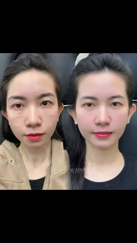 Từ gương mặt kém hài hòa, cằm chưa chuẩn form, hóc mắt bị tiêm lỗi ở nơi khác… 💉 Sau khi được chỉnh cằm, vi điểm má nâng tầng mặt và xử lý tan hóc mắt – trộm vía tiêm xong không sưng, nhan sắc “lên hạng” ngay tức thì. Nhìn mà cứ tưởng vừa thay một gương mặt mới – sắc nét, tươi trẻ, cuốn hút khó rời mắt  #tienleacadamy #filler #botox #tienle #tiemmoifiller 