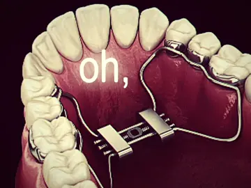 Every mans dream#CapCut #maxilla #expander #looks #bones #braces #orthodontics 