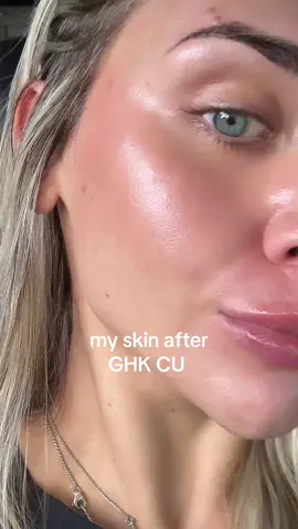 the results speak for themselves. ghk cu has made my skin resilient, glowy, and has healed my scars. along with a simple skincare routine. i quit using all the expensive medical grade & swapped to medicube red line and retinol. #ghkcu #glow #acne #acne 