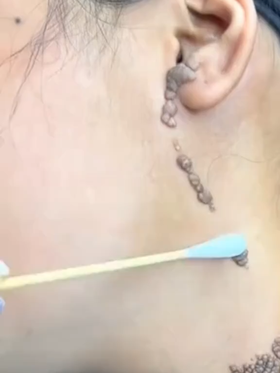 ⚡ ¡Últimas unidades! Nuestra crema quita verrugas actúa rápido y eficaz, dejando tu piel lisa y sin marcas. No dejes que esas imperfecciones te acompañen más tiempo… ¡Aprovecha antes de que se agote! 🖤✨