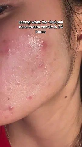trying the viral Lion pair acne cream once again! seeing the transformation in 24 hours! #lionpairacnecream #acne #acneproneskin #jbeauty #skincare 