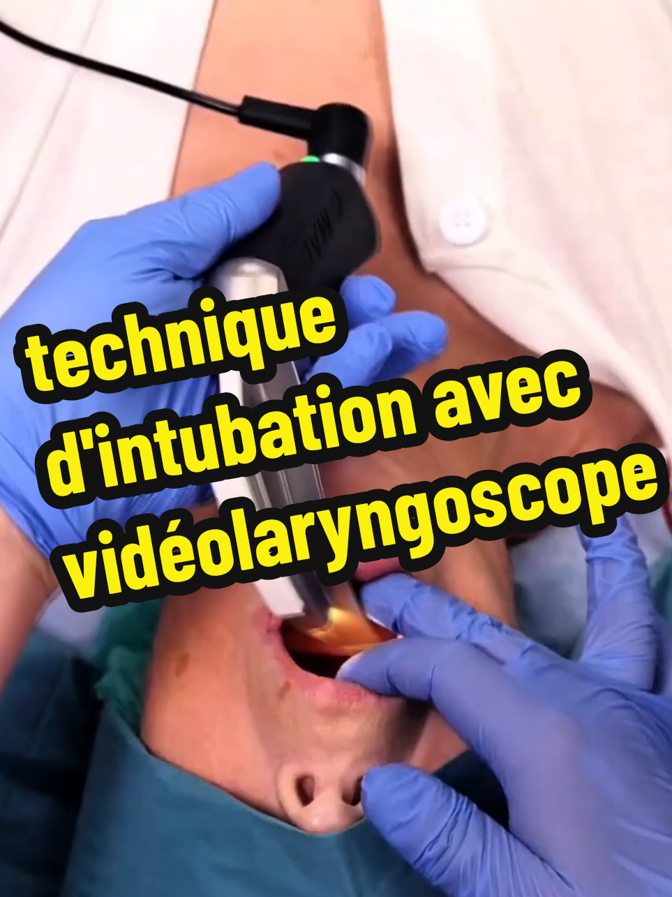 La vidéolaryngoscopie est une technique d'intubation qui utilise un laryngoscope doté d'une caméra pour visualiser les voies respiratoires et faciliter l'insertion du tube endotrachéal. Cette méthode offre une meilleure vue du larynx et des cordes vocales, ce qui peut être particulièrement utile dans les cas d'intubation difficile.  #anesthesia #intubation #medicalstudent #nurselife #medicaltiktok 