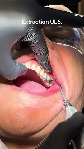 Upper molar extraction made easy. #dentalstudents #maxillofacial #dentist #oralsurgery #ليبيا_طرابلس_مصر_تونس_المغرب_الخليج #الامارات_السعوديه_الكويت_البحرين_عمان #extraction #dentalschool #