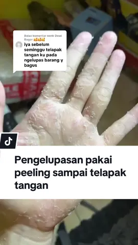 Membalas @nenk Dewi Bogor 🥰🥰🥰 eksfoliasi sampai telapak tangan pakai serum peeling laushine pengelupasan#fyp #fypシ゚ #laushine 