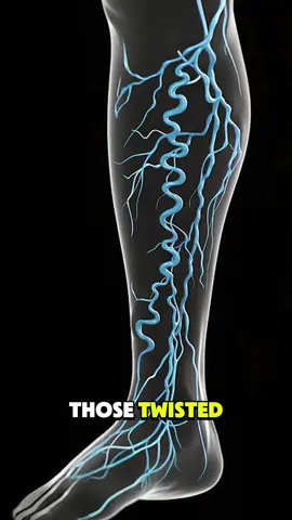 Varicose Veins Explained-3D Animation  #VaricoseVeins #VeinTreatment #VeinHealth #VascularHealth #VeinCare #Circulation #medical3danimation 