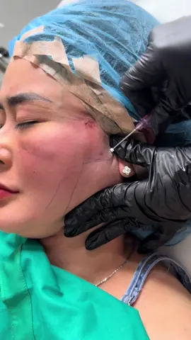 Căng chỉ nâng cơ táo bên nhà em hiẹu quả quá mọi người ạ thay đổi được hoàng toàn gương mặt cho chị khách, giảm thiểu được việc chảy xệ trong vòng 2 năm tới , giúp da săn chắc, tăng sinh collagen , tái tạo lại cấu trúc bên trong #fypシ゚ #fyp #làmđẹp 