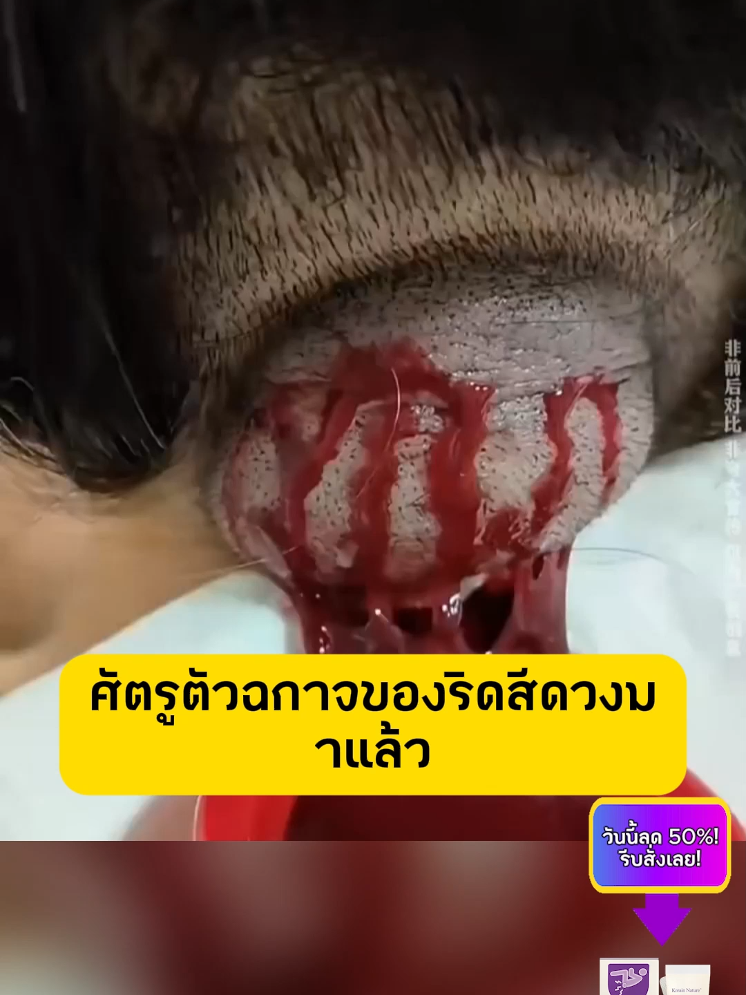 พุงหาย ริดสีดวงยุบ แค่ทาครีมนี้ทุกวัน! ปลอดภัย 100% วันนี้ลด 50%!