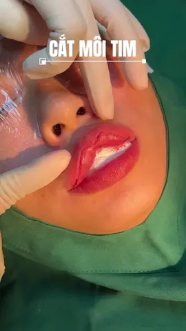 Tạo hình môi tim khoé cười tự nhiên. #CapCut #ThuyLeClinic #PhongKhamThuyLe #PhauThuatAnToan #CatMiTuNhien 
