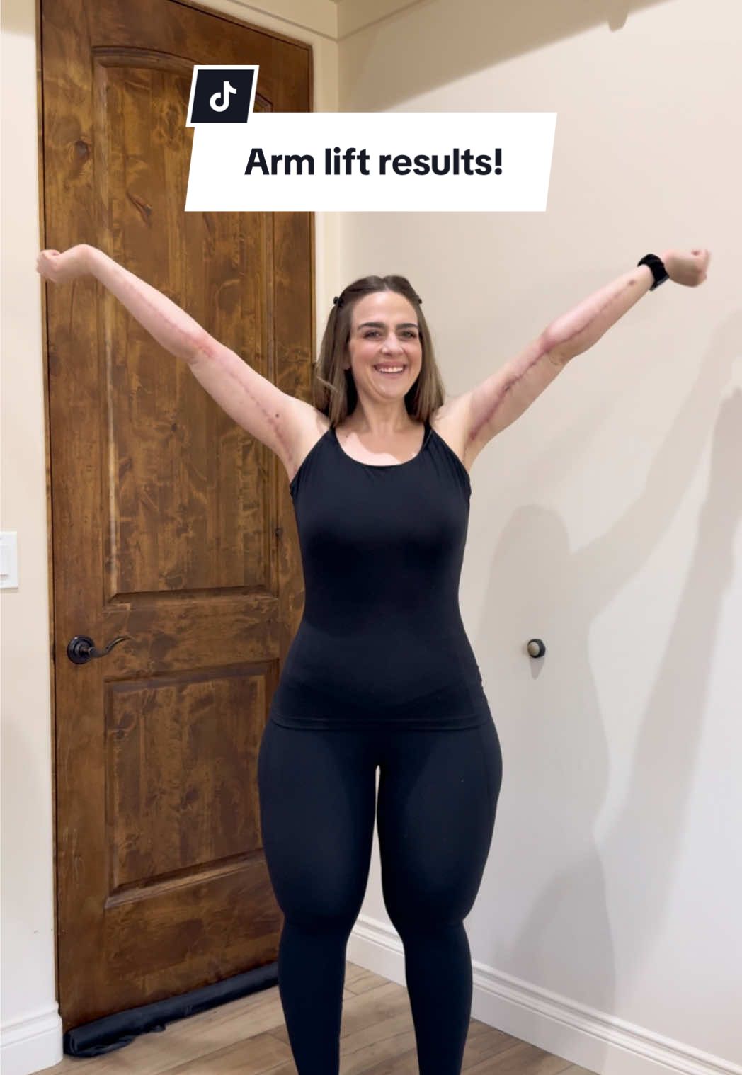 “If you love yourself, why are you changing yourself?” I got asked this question recently. Let me be clear, it is because I love myself that I choose to change myself. It’s because I love myself that I move towards growth. It’s why I show up for myself with honesty, intention and compassion. It’s why I reflect, why I heal, why I challnege old patterns and unhealthy habits and why I make decisions that I believe will honor the life I want to live. After losing over 200lbs I was left with loose skin that no amount of time, strength training or fasting could remove… no matter what people who have never experienced this like to tell me. My surgeries are not about vanity, they’re about freedom. About comfort. About getting to fully experience the life I worked so hard to gain. About feeling at home in my body. And about getting to see what my body might have looked and felt like had I never taken it for granted for so long. It is because I love myself that I lost weight and gained health. It is because I love myself that I am removing the loose skin from my body and getting my lipedema treated. I don’t believe self love and self improvement are opposites. You can love yourself and change yourself. That doesn’t mean you don’t accept yourself and it doesn’t mean you don’t think you’re enough as you are, it means you’ve seen where your life can improve and you want to work towards that vision for your future. Make no mistake, I’ve never loved myself more. Not because I’m smaller. Not because my loose skin is gone. Because I know what I want for my life and out of life and I intentionally move toward that with each decision I make. 💜 Thank you @modernplasticsurgery for helping me feeling more at home in my body! And thank you @Advanced Lipedema Treatment program at @The Roxbury Institute for taking such good care of me! 🤗 #DrShawnMoshrefi #ALTProgram #Partner #brachioplasty #beforeandafter  *All surgeries come with risks and everyone has to decide what the best option for them is.