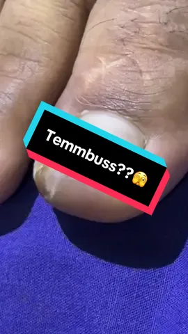 Hampir aj… 😅😅 #cantengan #doktercantengan #waduhwaduh #cantengantanpacabutkuku #podiatrist #pedicuretime #cabutkuku #nailcare #medicalpedicure 