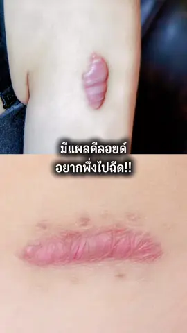 ดูก่อนอย่าพึ่งไป ฉ   ี  ด  !!! #แผ่นแปะลดรอยแผลเป็น #แผ่นซิลิโคนลดรอยแผลเป็น #คีลอยด์ 