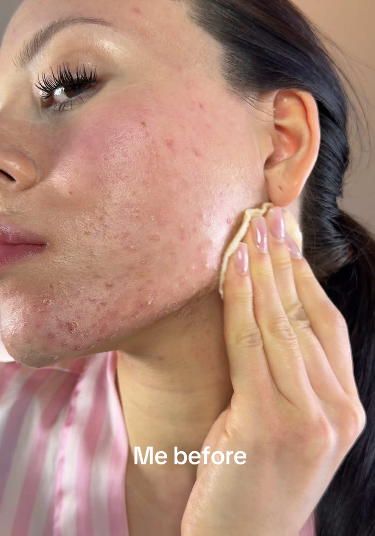 My progress ❤️‍🩹 #acnefighter #acneproneskin #fyp #fyppppppppppppppppppppppp #makemeviral #makemefamouse #virał 