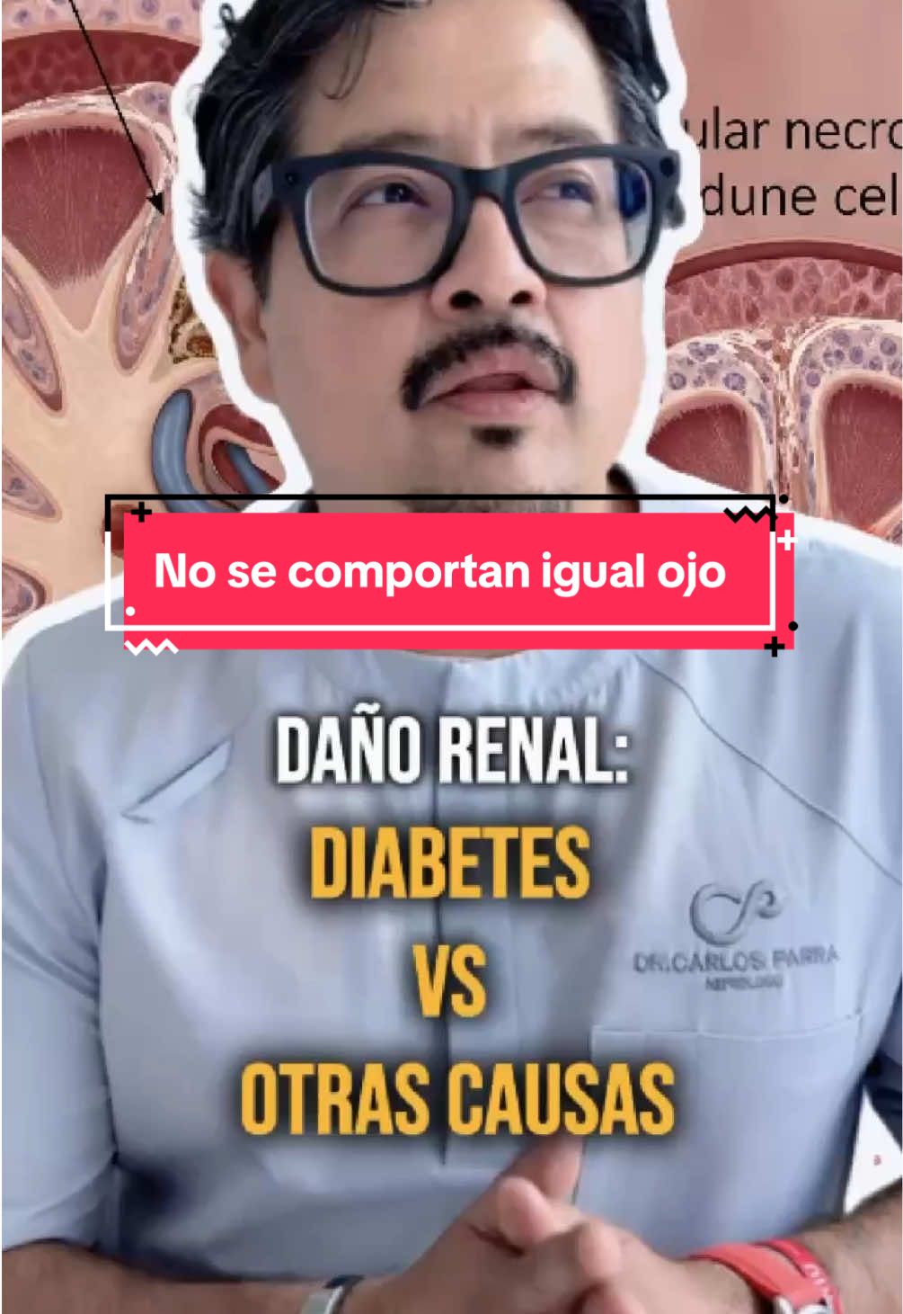 La nefropatía diabética es diferente a otras causas de daño renal, como la enfermedad renal poliquística o el riñón chico, sin embargo, todos te dirán que son igualmente progresivas, y eso es un gran error #nefropatiadiabetica #glomerulopatia #fallarenal #erpa #dialisis 