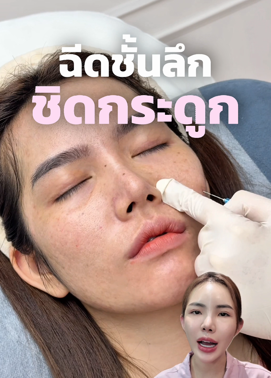 ฟิลเลอร์ใต้ตาเทคนิคไม่เป็นก้อน #หมอแพมkisssi #ฟิลเลอร์ใต้ตา #ใต้ตาเป็นก้อน #ฟิลเลอร์หน้าแก้ม #ฟิลเลอร์ชั้นลึกชิดกระดูก #ฟิลเลอร์แก้มส้ม 