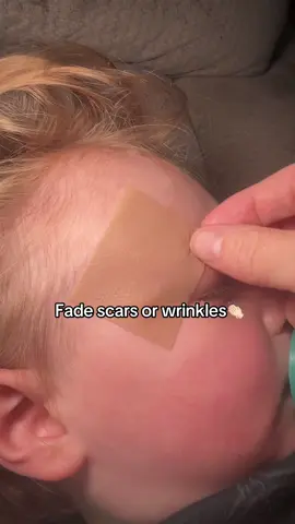 So glad I found this stuff for my baby’s scar! #scar #scartape #siliconescartape #wrinkles #scarremoval #wrinklesbegone #siliconescarsheets #scartapeforwrinkles #skincare #stitches #dealsforyou #dealsforyoudays #tiktokshopmademebuyit 
